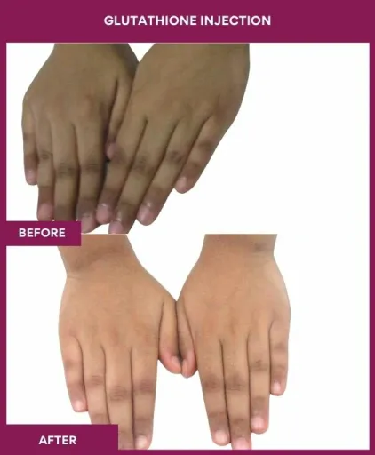 13 Glutha Injection (2)