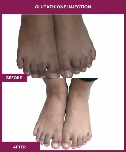 13 Glutha Injection (3)