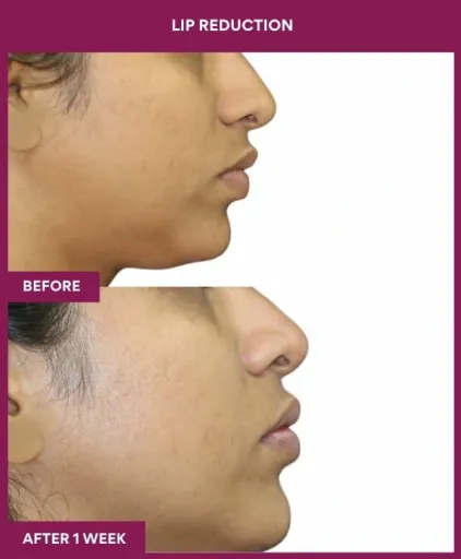 13 LIP REDUCTION (3)