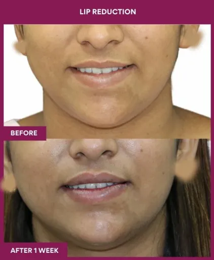 13 LIP REDUCTION (4)