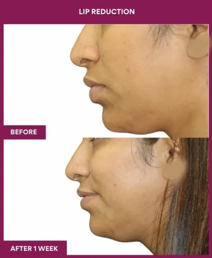 13 LIP REDUCTION (5)