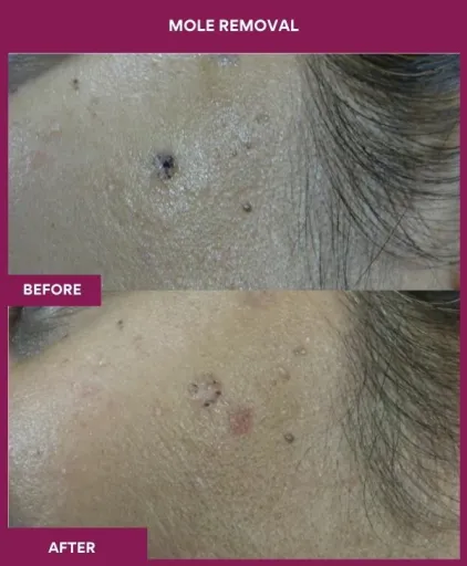 13 Mole Removal