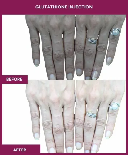 14 Glutha Injection (2)