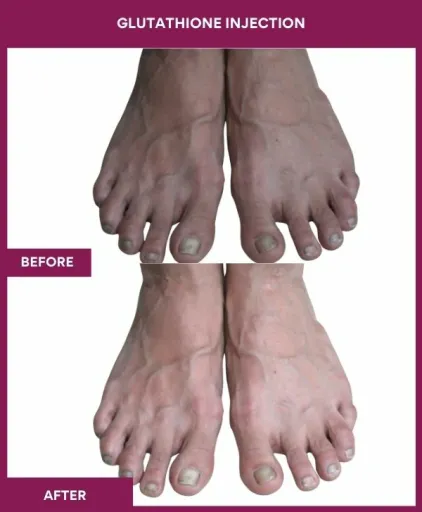 14 Glutha Injection (3)