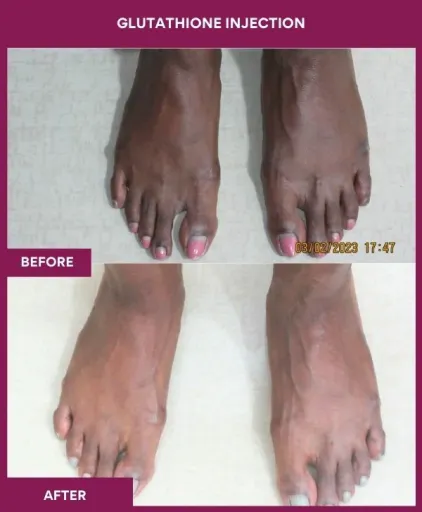 15 Glutha Injection (2)