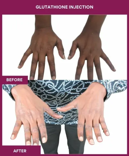 15 Glutha Injection (3)