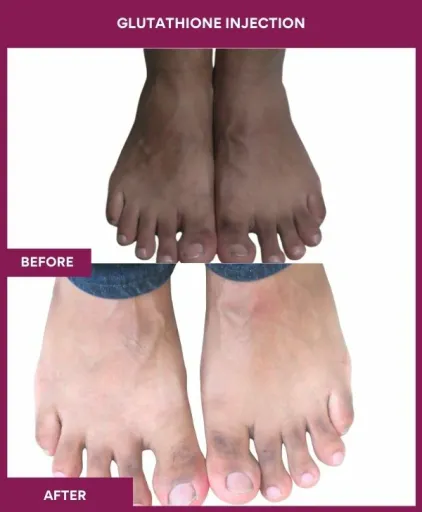 16 Glutha Injection (2)