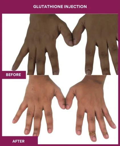 16 Glutha Injection (3)