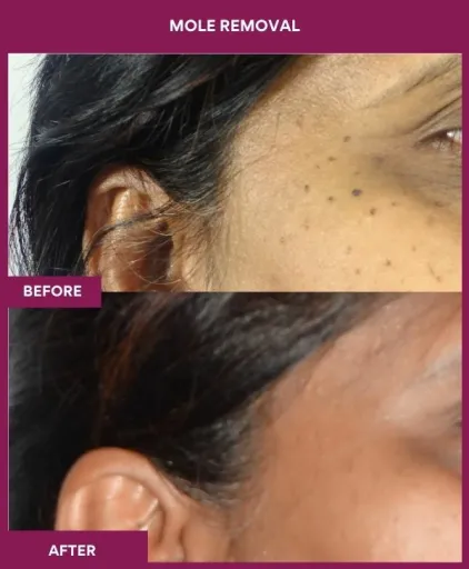 16 Mole Removal (3)