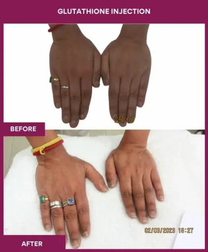 17 Glutha Injection (2)