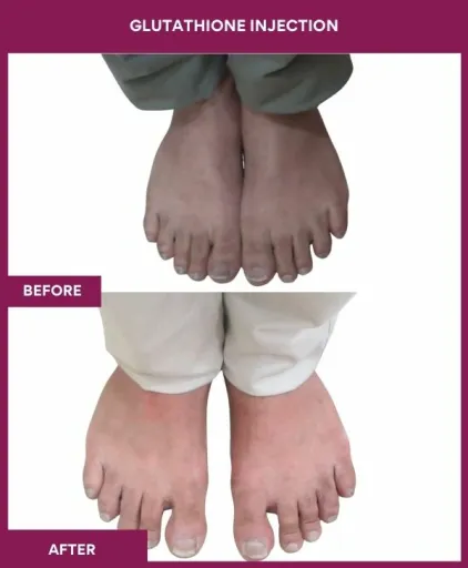 17 Glutha Injection (3)