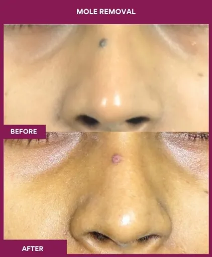 17 Mole Removal
