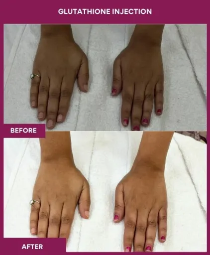 18 Glutha Injection (2)