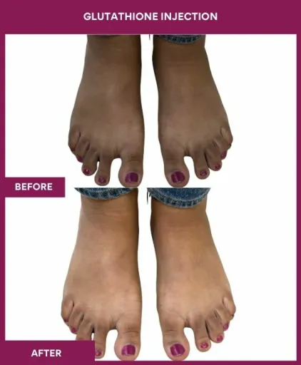 18 Glutha Injection (3)