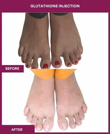 19 Glutha Injection (2)