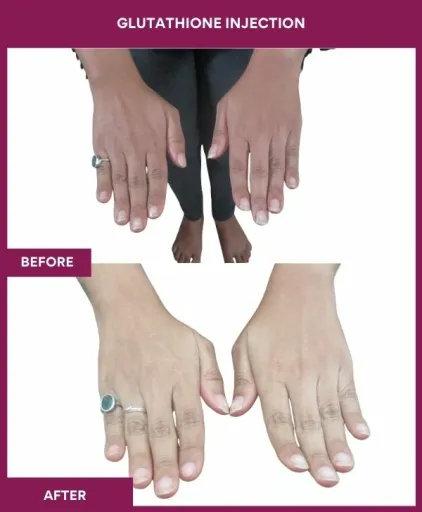 19 Glutha Injection (3)