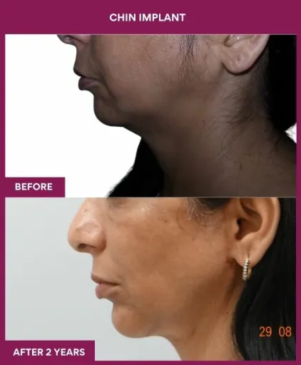 2 Chin Implant (3)