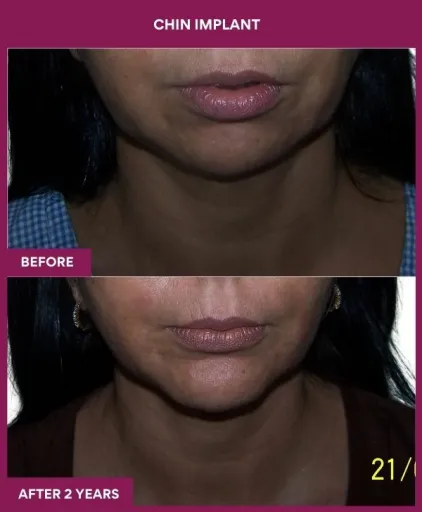 2 Chin Implant