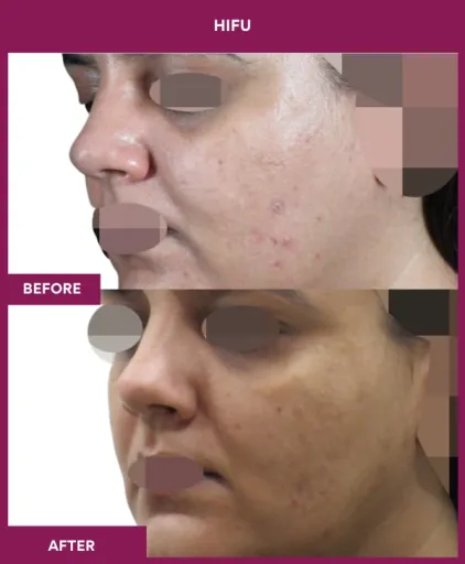 Hifu Treatment in Mumbai