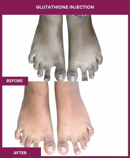 20 Glutha Injection (2)