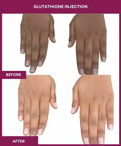 20 Glutha Injection (3)