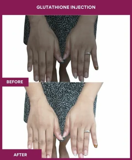 21 Glutha Injection (2)