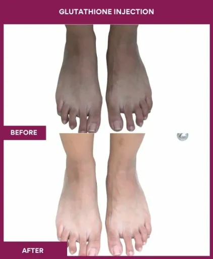 21 Glutha Injection (3)