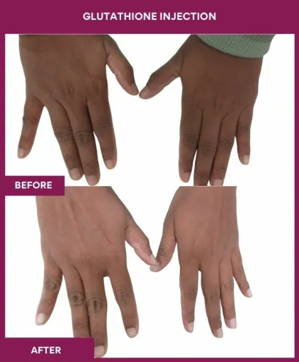 22 Glutha Injection (2)