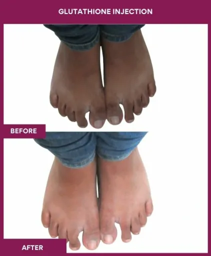 22 Glutha Injection (3)