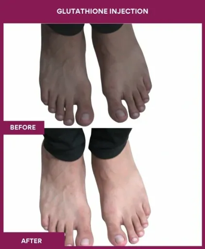 23 Glutha Injection (3)