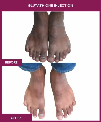 24 Glutha Injection (2)