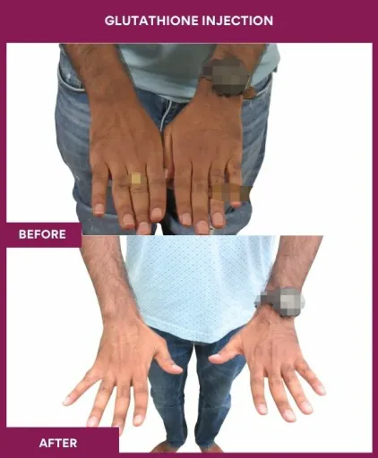 24 Glutha Injection (3)