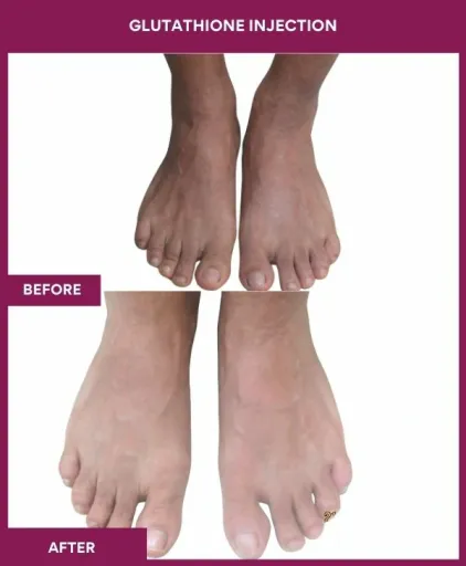 25 Glutha Injection (2)