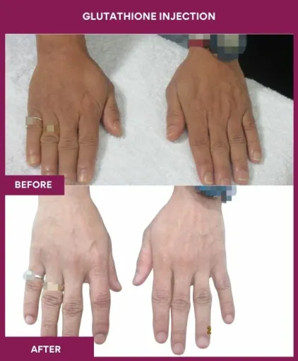 25 Glutha Injection (3)