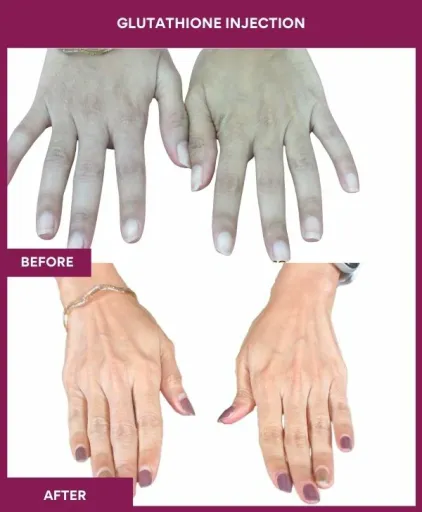 26 Glutha Injection (2)