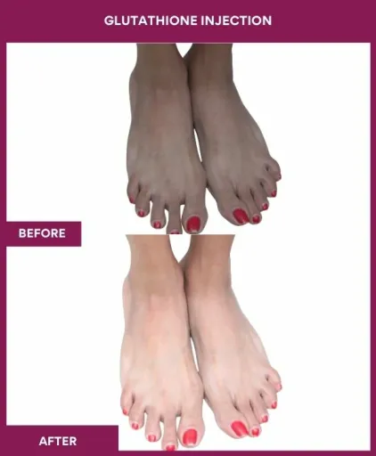 26 Glutha Injection (3)