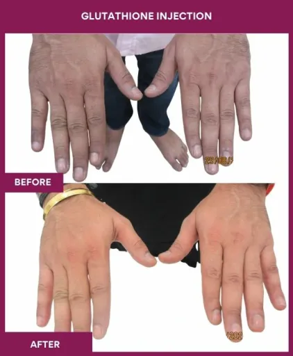 27 Glutha Injection (2)