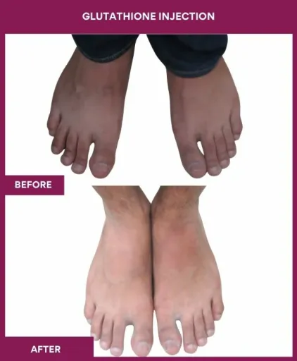 27 Glutha Injection (3)