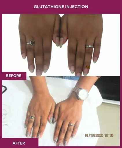 28 Glutha Injection (2)