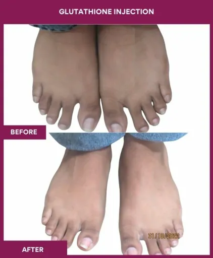 28 Glutha Injection (3)