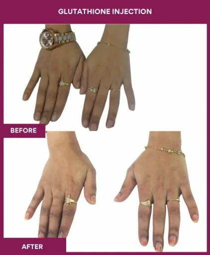 29 Glutha Injection (2)