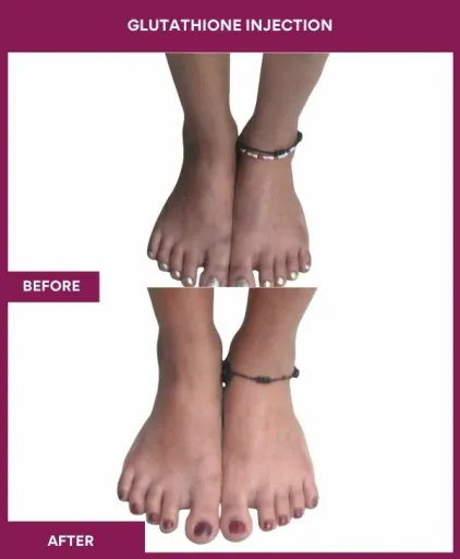 29 Glutha Injection (3)