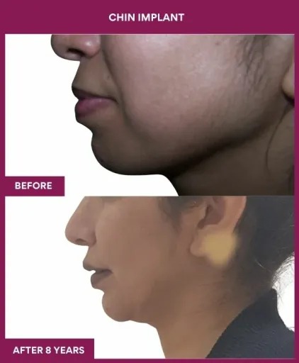 3 Chin Implant (2)