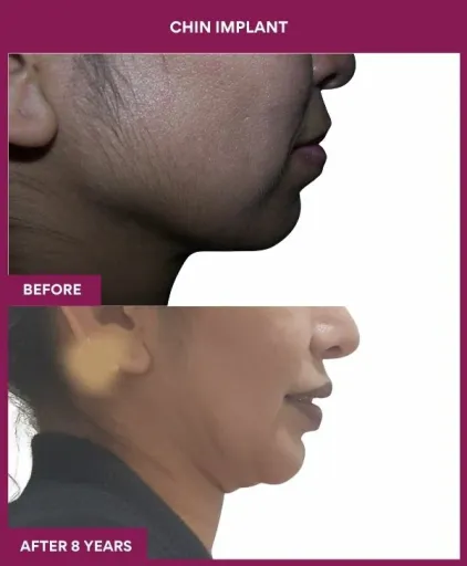 3 Chin Implant (3)