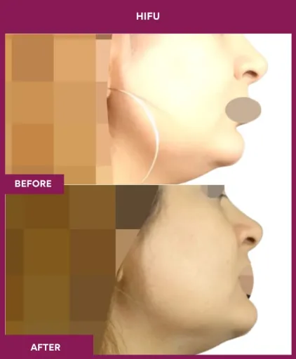 Hifu Treatment in Mumbai