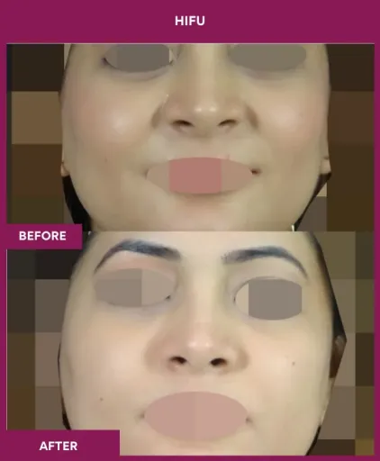 Hifu Treatment in Mumbai