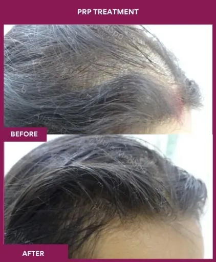 3 PRP Treatment (2)_2