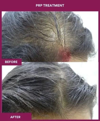 3 PRP Treatment (3)_2