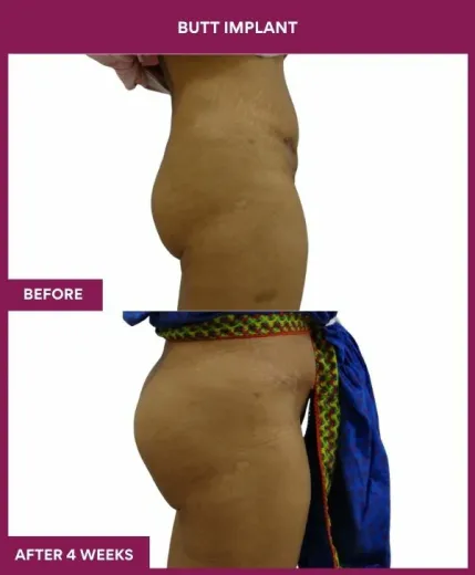 4 BUTT implant (2)