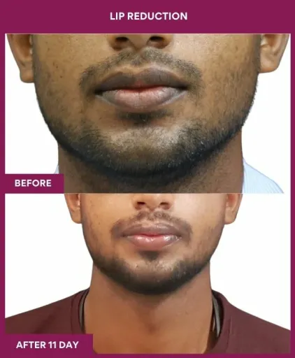 4 LIP REDUCTION